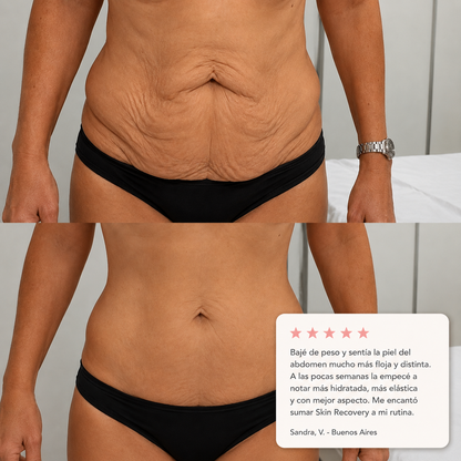 SKIN RECOVERY - REAFIRMANTE CORPORAL POST BAJADA DE PESO